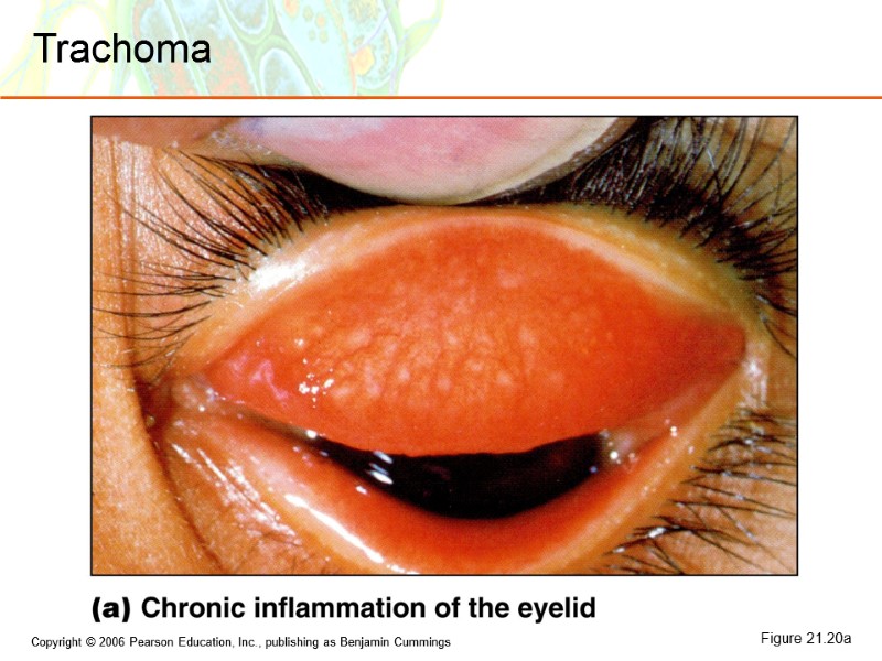 Figure 21.20a Trachoma